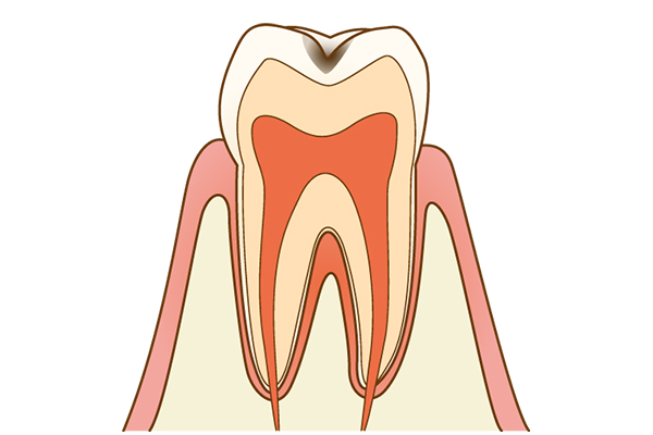 虫歯治療