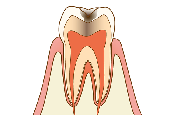 虫歯治療