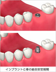 インプラント治療