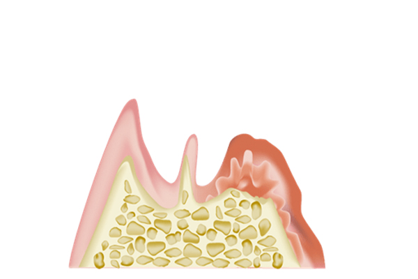 歯周病治療
